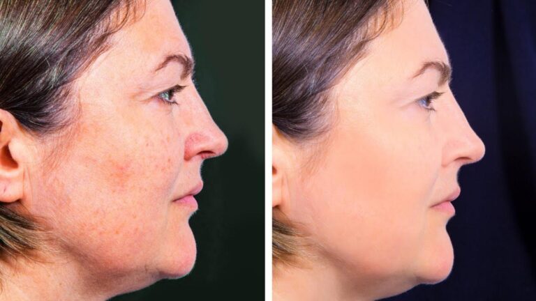 Cette vieille astuce naturelle pour effacer les taches de peau va vous étonner…