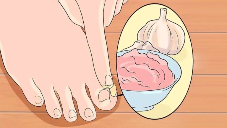 Découvrez 5 bienfaits surprenants de la pâte d&rsquo;ail pour vos pieds !