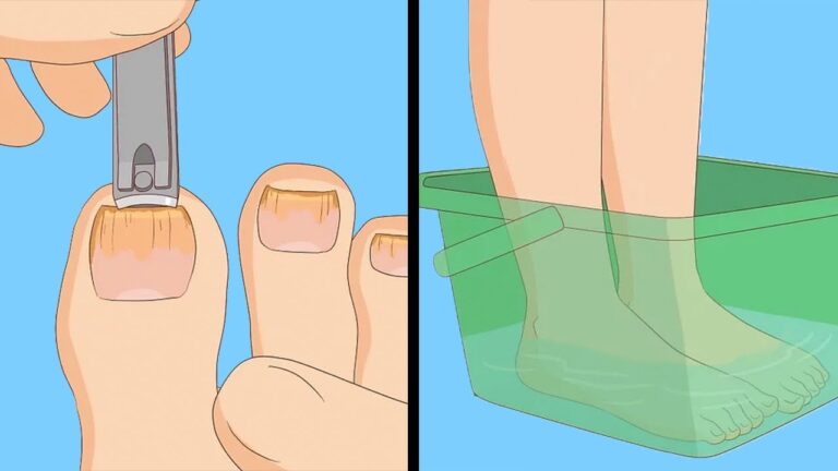7 astuces quotidiennes pour éliminer le champignon des ongles durablement !